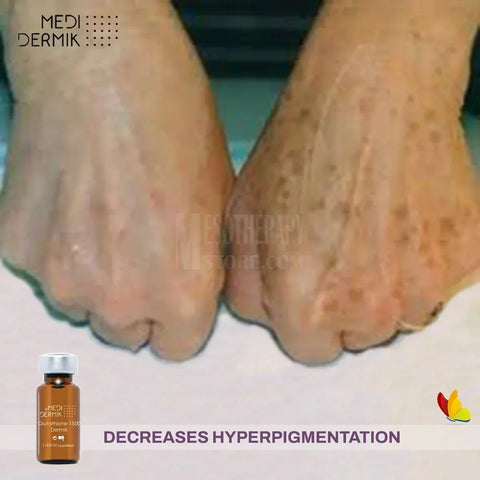 glutathione mesotherapy before and after for Skin in Hyderabad Glutathione 1500 Dermik Lyophilized By
